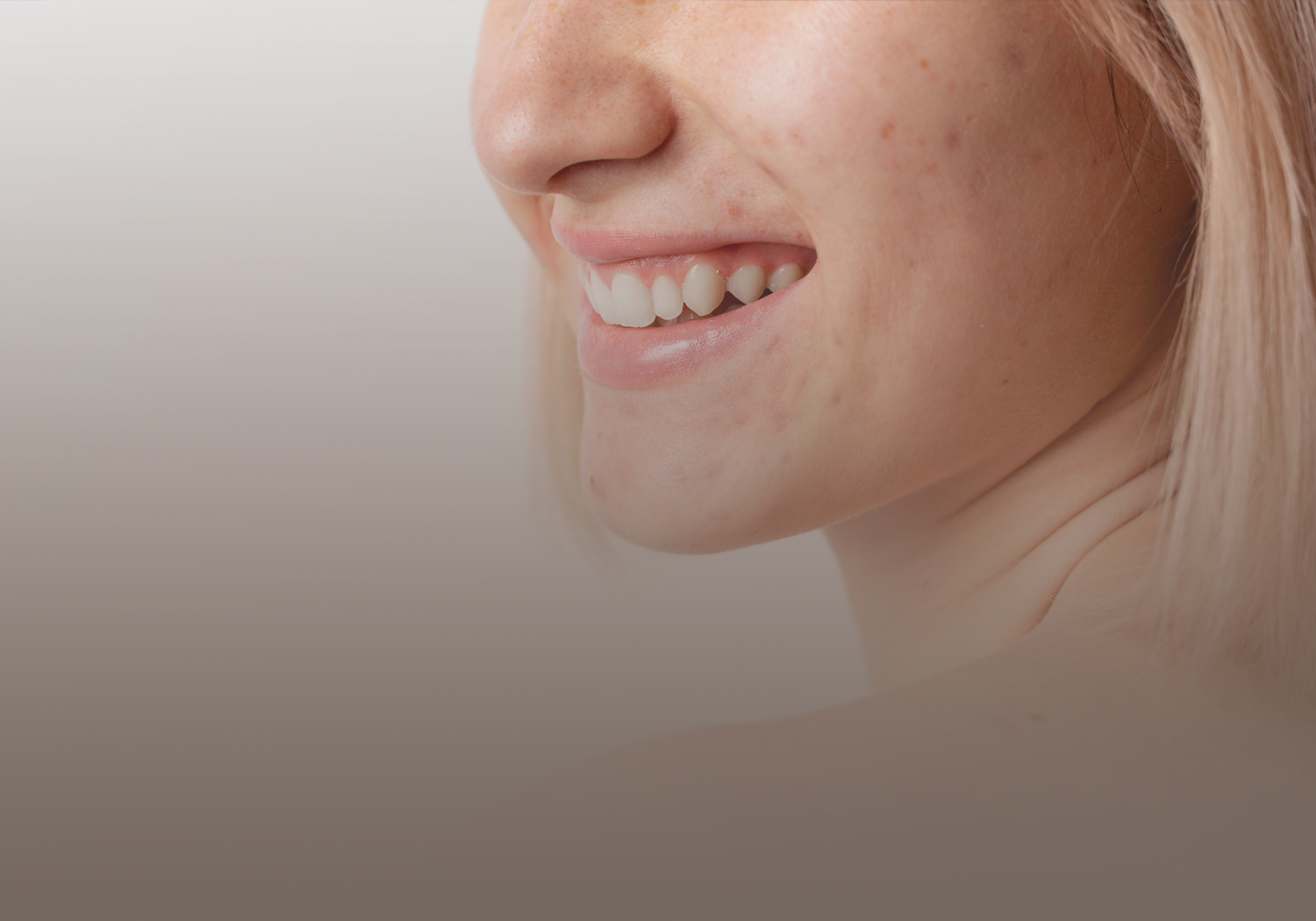 Acne_555