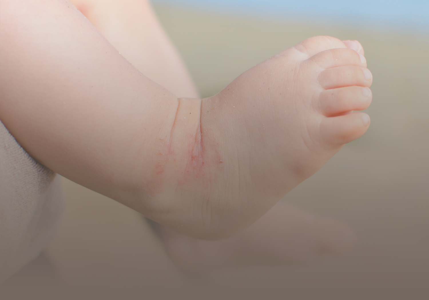 Atopic_Dermatitis_555