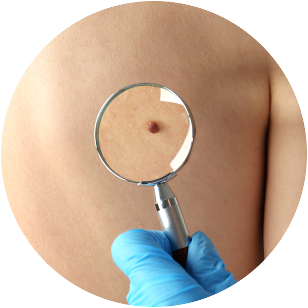 BellaNova_Mole_Remover_541