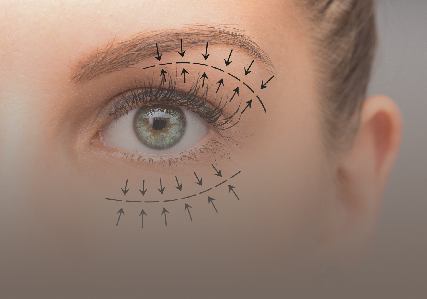 Blepharoplasty_555