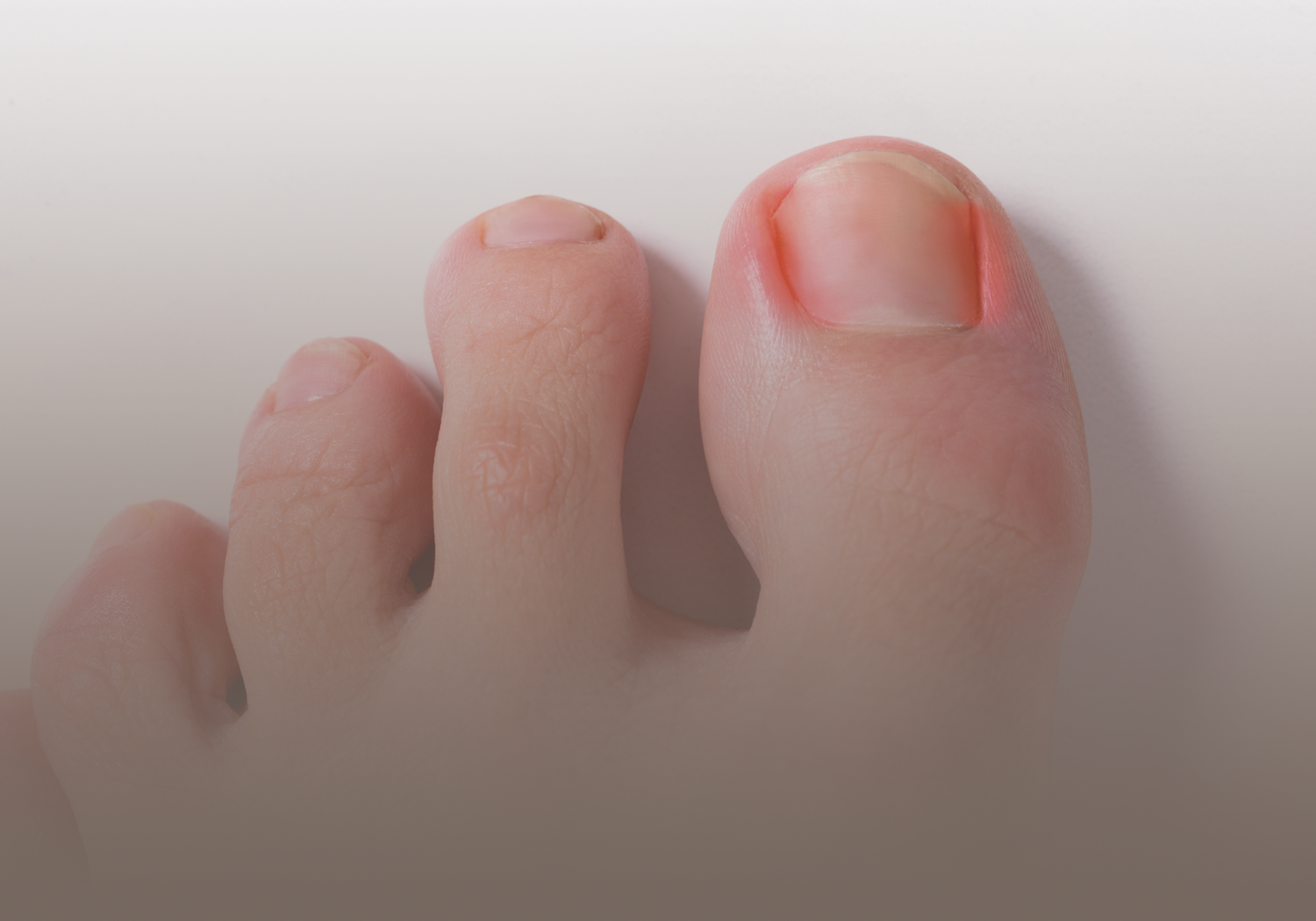 Derma_Ingrown_Toenail_331