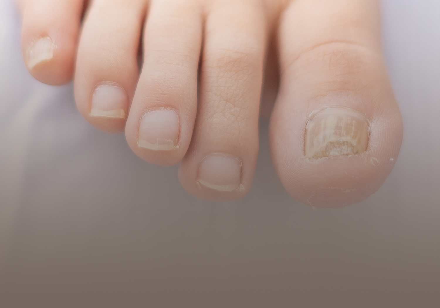 Derma_Onychomycosis_331