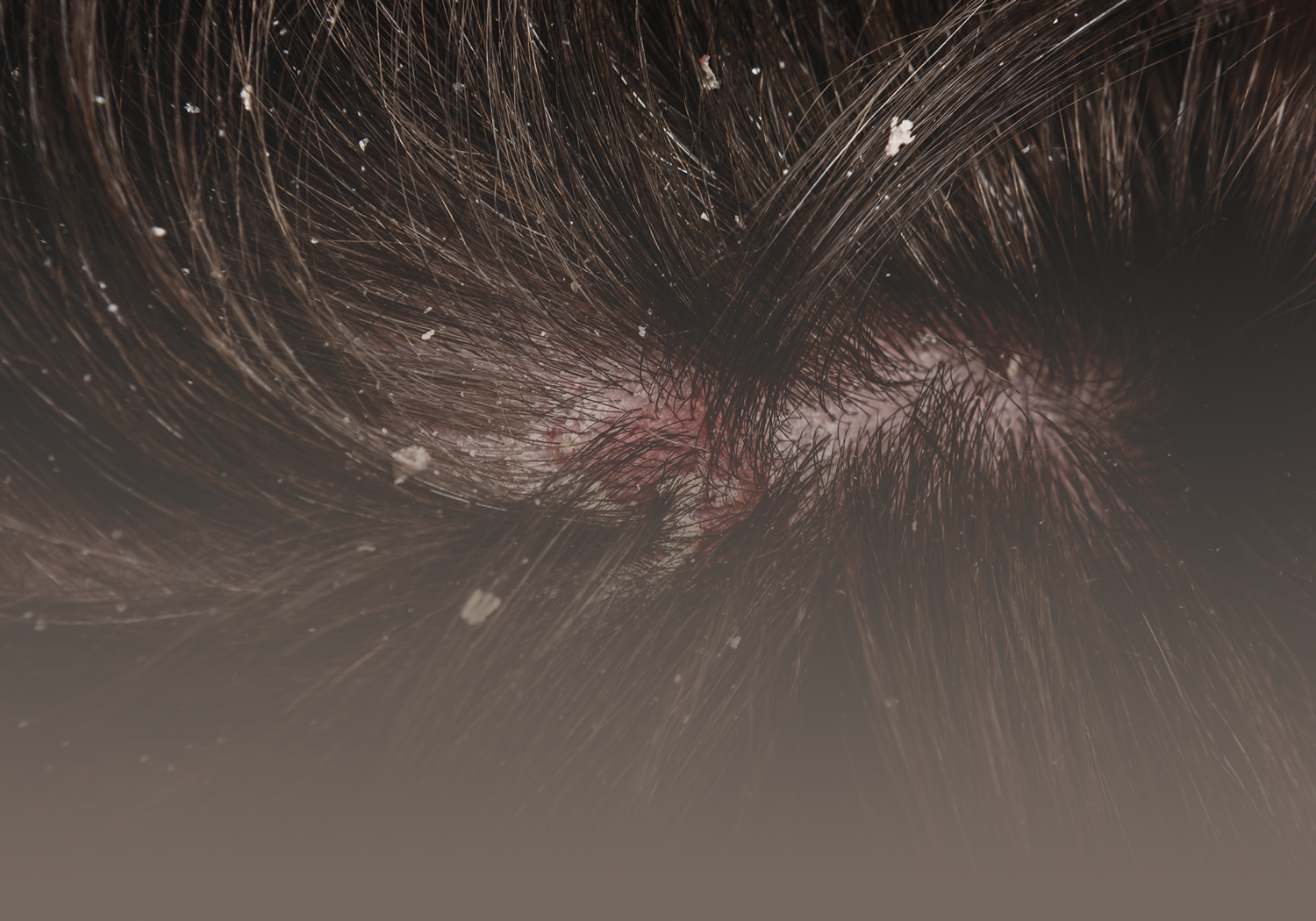 Derma_Seborrheic_Dermatitis_44