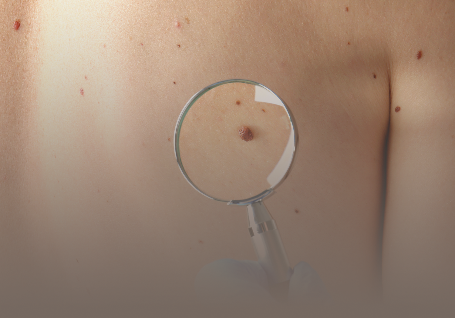 Excision_of_Benign_Skin_Tumors_555