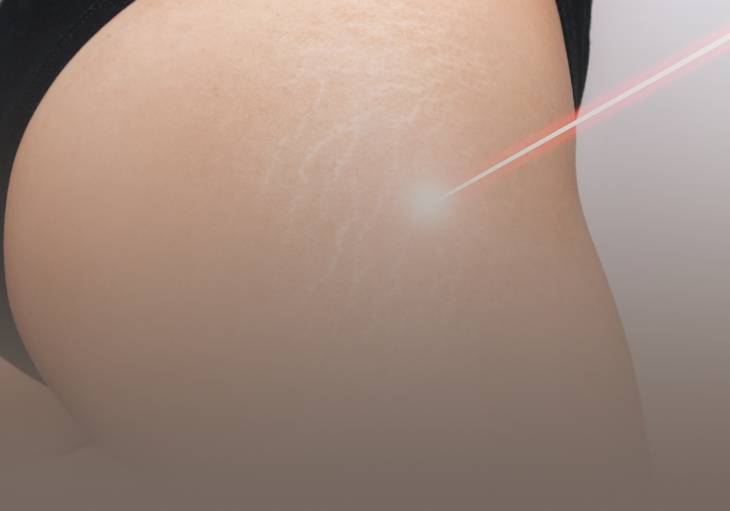 Laser_Stretch_Marks_555