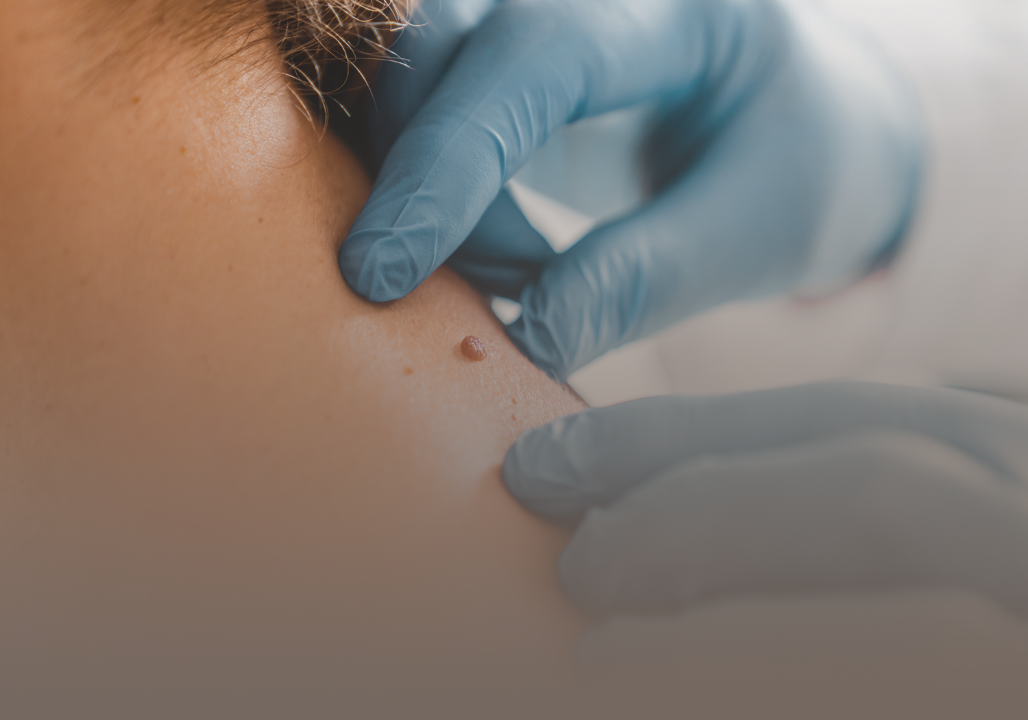 Mole_Removal_555