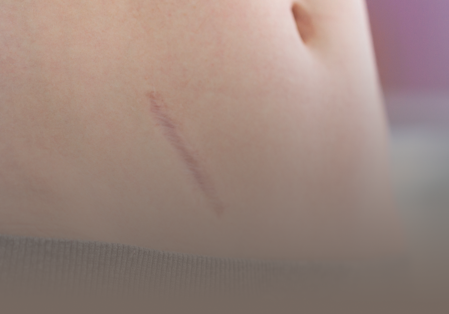 Post-Traumatic_Scars_555