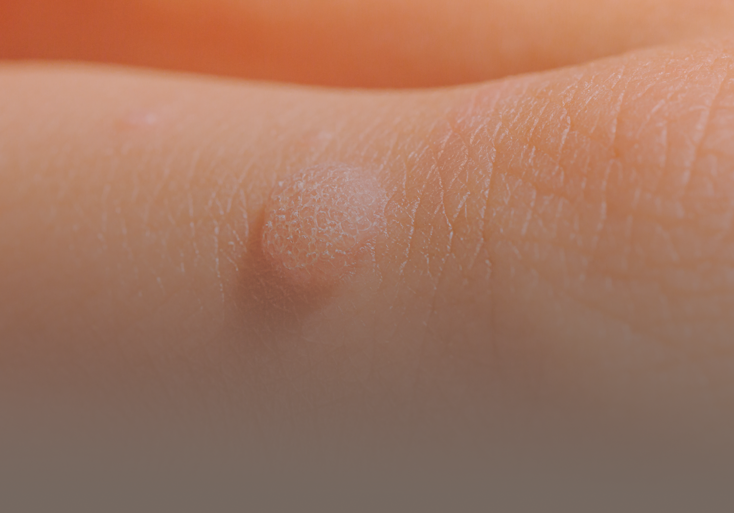 Sebaceous_Cysts_555