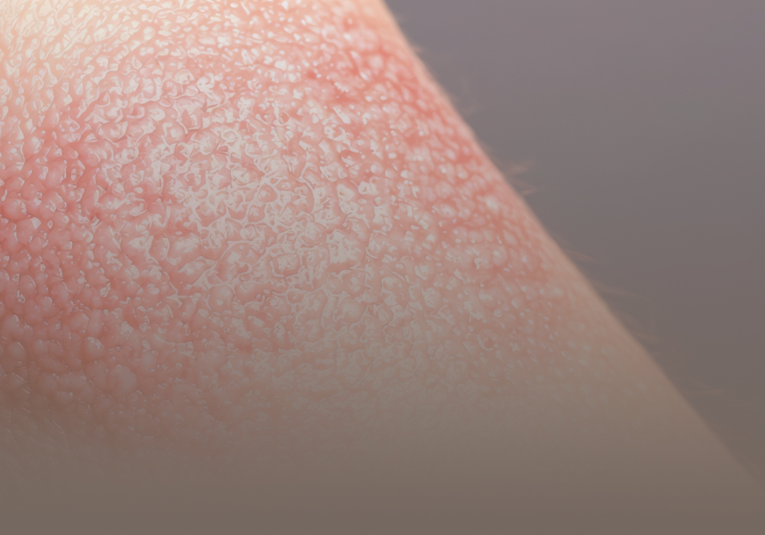 Service_Atopic_Dermatitis_433