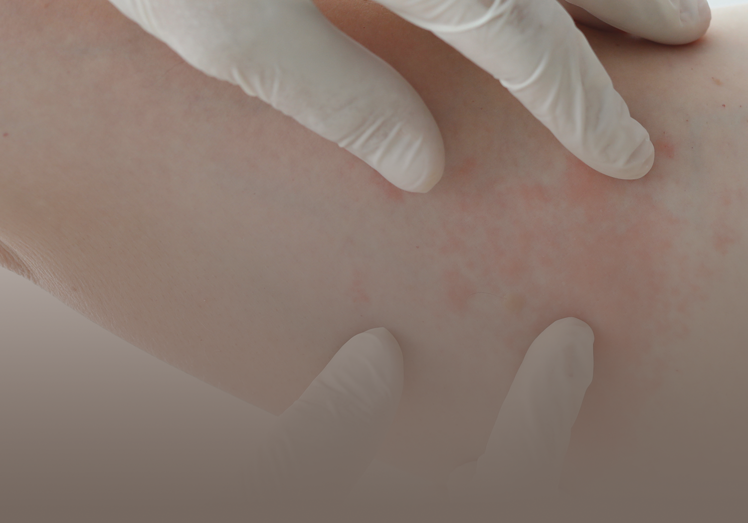 Service_Bacterial_Skin_Infections_55