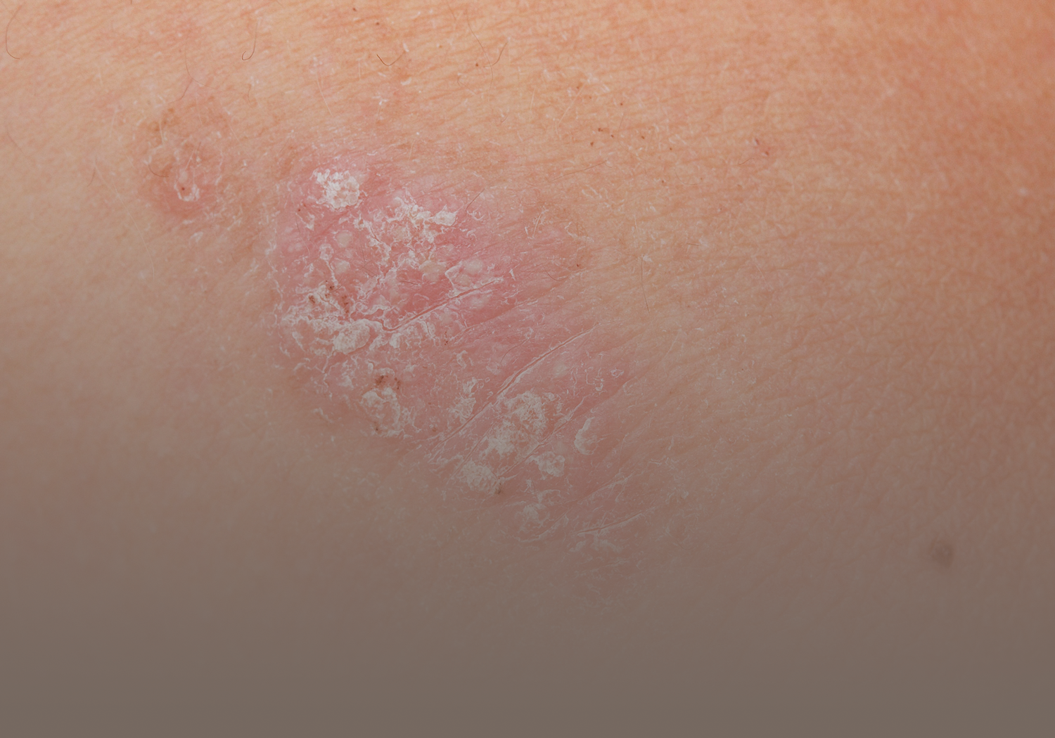 Service_Psoriasis_5541