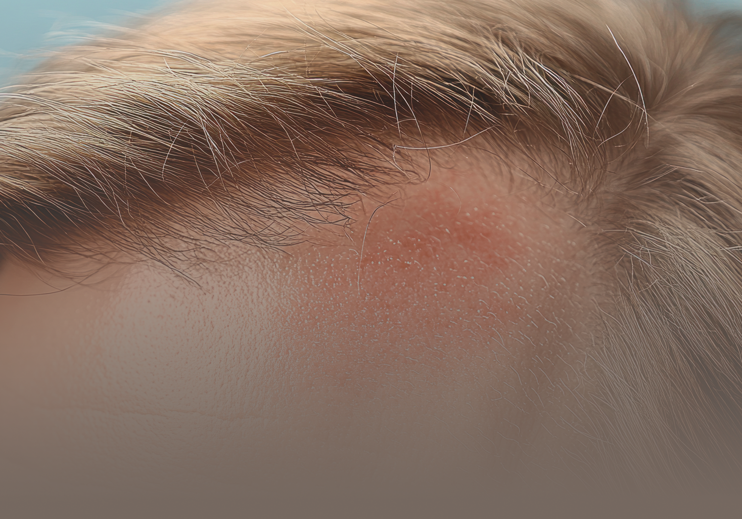Service_Seborrheic_Dermatitis_333