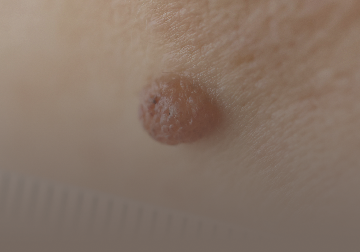Service_papillomas_5531