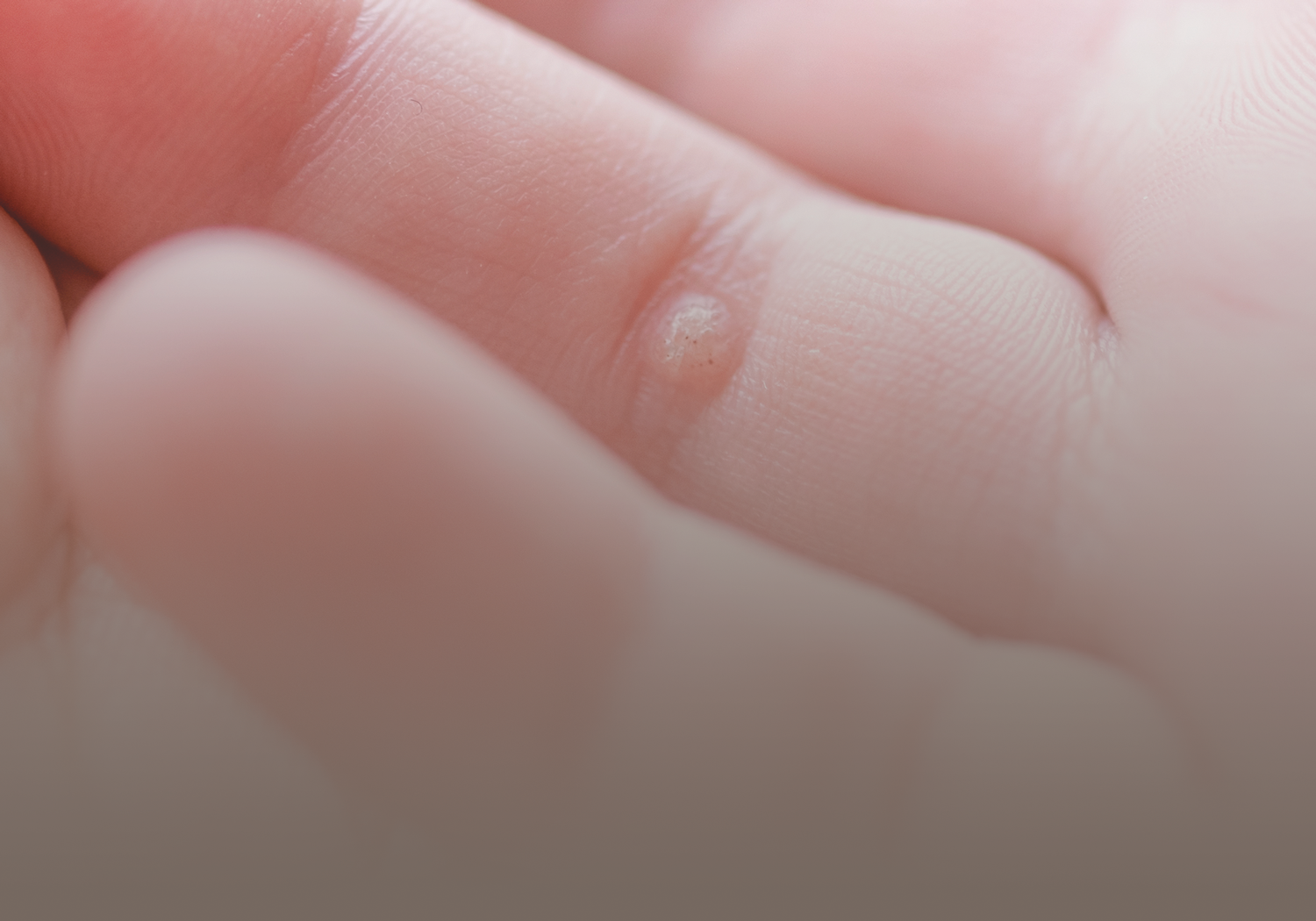 Warts_555