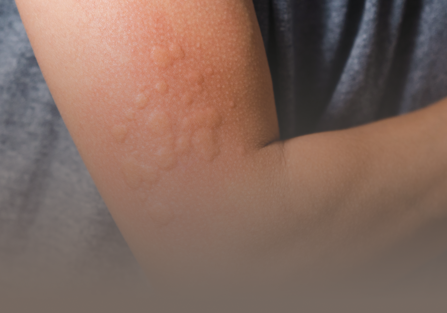 urticaria-555